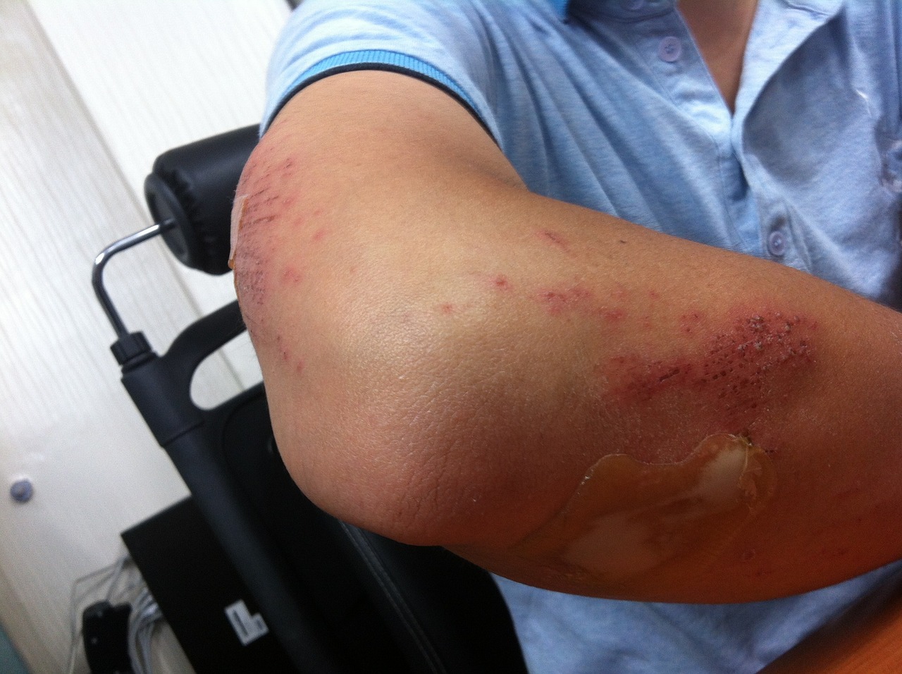 Metal factory worker suffers arm burns in workplace accident